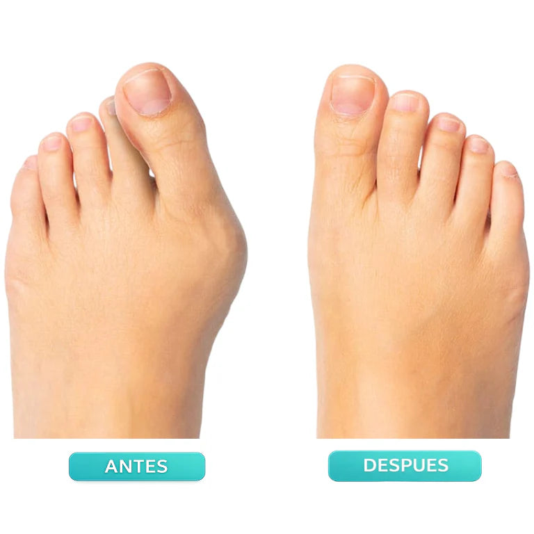 Corrector Ajustable para Juanetes OrtoFlex™