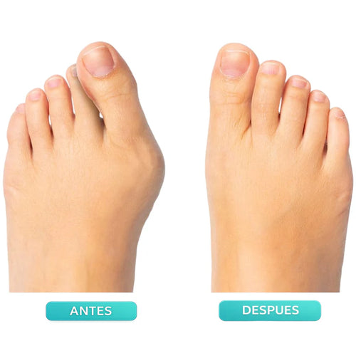 Corrector Ajustable para Juanetes OrtoFlex™