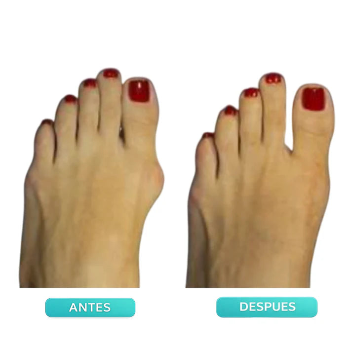 Corrector Ajustable para Juanetes OrtoFlex™